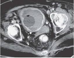 The Urinary Bladder Radiology Key