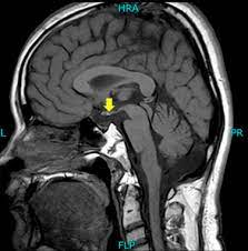 Pituitary Stalk Interruption Syndrome Presenting In A Euthyroid Adult With Short Stature Sciencedirect