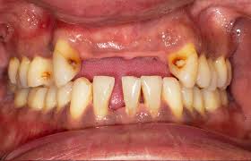 Periodontal disease results from plaque deposition on the teeth due to incorrect flossing and a significant procedure used by dentists to reverse dental bone loss is bone replacement through grafting techniques. Gum Disease Symptoms And Treatment The Implant Experts
