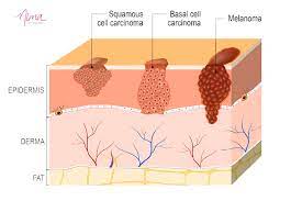 Pigmented basal cell skin cancer. Skin Cancer What You Need To Know Nima Skin Institute
