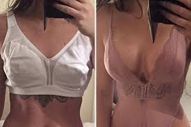 Résultat de recherche d'images pour "breast implant before and after"