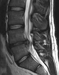Ia dalam bentuk suntikan untuk mengurangkan kesakitan. Spinal Disc Herniation
