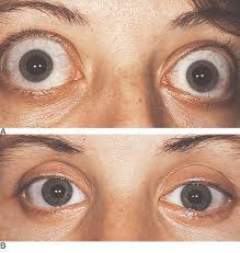 Image result for Proptosis