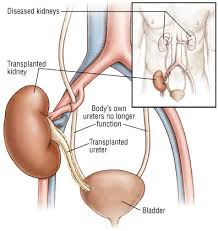 Image result for Transplantation