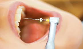Image result for root canal treatment