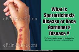 Check spelling or type a new query. Sporotrichosis Or Rose Gardener S Disease Types Transmission Symptoms Treatment Risk Factors Diagnosis