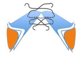 2015 may cited 2016 mar 18; Glottoplasty For Voice Feminization Medical Voice Center