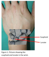 Image result for Scapholunate Dislocation