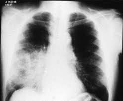 It's caused by the bacterium legionella pneumophila found in both potable and nonpotable water more hospitals are facing the dilemma of legionella outbreaks as they discover the drinking water is. Community Acquired Pneumonia By Legionella Pneumophila Serogroups 1 6 In Brazil Respiratory Medicine