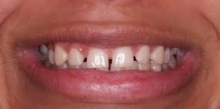 This gap teeth fix is not suitable for larger gaps, because bonding can make the teeth look too big. Gappy Smiles Close Gaps In Between Teeth Bespoke Smile