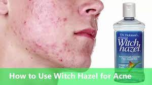 Maybe you would like to learn more about one of these? How To Use Witch Hazel For Acne Youtube