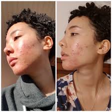 How long does a sharpie last on skin? Cheek Purge Acne
