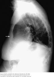 Image result for Sternal Fracture