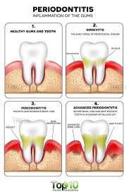 Self Care And Home Remedies To Stop Periodontitis Gum Disease Treatment Gum Disease Remedies Periodontitis