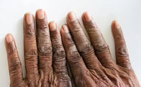 Image result for dyshidrosis