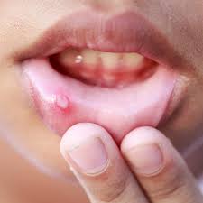 I have posted a message in the community forum regarding these current developments sbut would also very much value your. Common And Serious Side Effects Of Valacyclovir Roman Healthguide