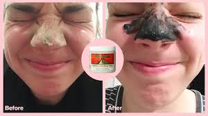 Maybe you would like to learn more about one of these? Charcoal Mask Benefits How To Apply And What To Know