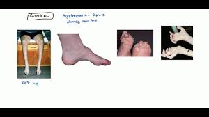 This damage is mostly in your arms and legs (peripheral nerves). Charcot Marie Tooth Syndrome For Usmle Youtube