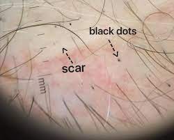 If your skin is pale and your hair color is dark, you're more likely to notice it. Dr Donovan S Hair Loss Articles 2011 2021 Donovan Hair Clinic