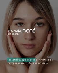 ¿Sabías que no todos los tipos de acné se tratan igual?, Uno de los motivos  por los que muchas personas no mejoran —o incluso empeoran— es porque están  usando productos o tratamientos que no ...