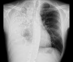 Heart failure 3, causes of left ventricular failure. Initial Chest Radiograph Revealing Large Loculated Pleural Effusion In Download Scientific Diagram