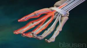 Dette vil gi nedsatt følelse, og er typisk i føttene hos diabetikere. Karpaltunnelsyndrom Nhi No