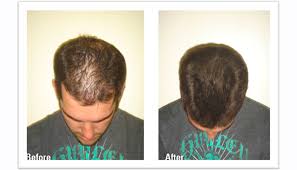 A bald spot in the crown may be a good indication that you are losing hair for genetic reasons but isn't necessarily the case. Crown Hair Transplant Treatment In India Procedure Cost Insta