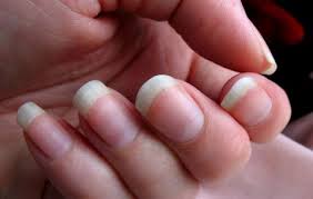 Kuku jari kaki yang kejatuhan benda berat dapat kemudian mengalami perubahan warna menjadi kehitaman. Kotoran Di Bawah Kuku Apakah Menghalangi Sahnya Wudhu