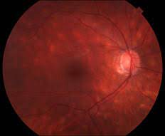 Birdshot Retinochoroidopathy Eyewiki