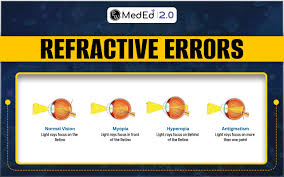 Image result for Refractive Error