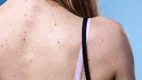 Tinea versicolor is a skin infection caused by fungus and appear as light brown or white patches on the skin. What Is Tinea Versicolor Symptoms Causes Treatment And Prevention Everyday Health
