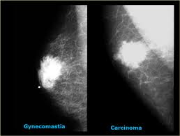 Reported sensitivities vary, but in general the overall sensitivity for detecting breast cancer. The Radiology Assistant Pathology Of The Male Breast