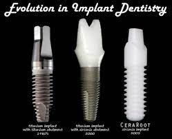 Now can you imagine someone giving you out free implants which cost you an arm and a leg! Free Dental Implants Dental News Network