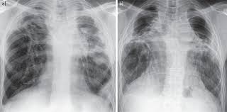 Learn about aspergillosis, an infection or allergic reaction caused by mold. Chronic Pulmonary Aspergillosis Rationale And Clinical Guidelines For Diagnosis And Management European Respiratory Society