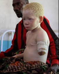 Varied use and interpretation of the terms mean that written reports of albinistic animals can be difficult to verify. Tanzanian Children With Albinism Hunted For Their Body Parts Receive Prosthetic Limbs And A New Lease On Life Abc News