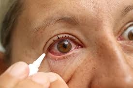 I do not sleep in them and i will occasionally take a day to just let my eyes breathe … read more. Entropion Symptoms Causes And Treatment