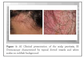 Image result for koebner phenomenon psoriasis