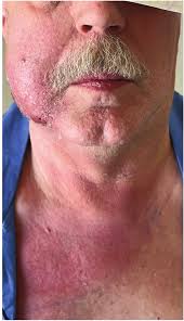 Image result for phlegmon on face)