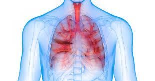 Pneumonia is a respiratory infection characterized by inflammation of the alveolar space and/or the interstitial tissue of the lungs. Bacterial Pneumonia Poz