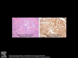 Consult a doctor for medical advice. Malignant Pleural Mesothelioma Ppt Download