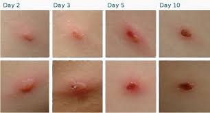 Chickenpox (or chicken pox) is an acute infectious disease. Chickenpox Sambungan Cikmelankolik