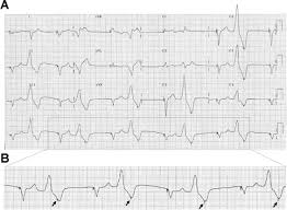 Eva vibeke kofoed pihl hold b humtek dato:03/06/2020. Repetitive Pacemaker Spike During The Vulnerable Period In A Cardiac Resynchronization Therapy Defibrillator Heart Rhythm
