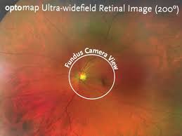 Operculated retinal tear an operculated tear results from vitreous traction that pulls a plug of sensory retina out into the vitreous cavity (see illustration). Introducing Our New Optos Daytona Tigard Eyecare