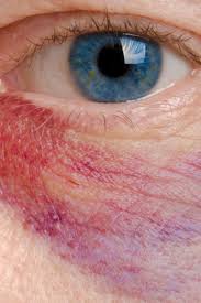 Blue with red poker dots. Allergic Shiners Symptoms Causes And Treatments