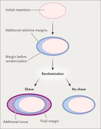 After visiting my surgeon he told me the cancer was a stage 2, and not to worry. A Randomized Controlled Trial Of Cavity Shave Margins In Breast Cancer Nejm