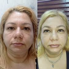 Antes y después de 2 sesiones de Hifu facial