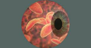 Porém, parasitas nos olhos são encontrados com pouca frequência. Parasita Da Toxoplasmose Causa Lesao Tipica E Se Espalha Pela Retina Jornal Da Usp