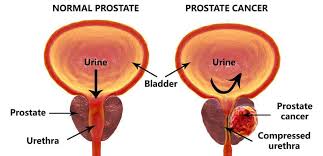 Prostate cancer metastasis may be suspected if you have specific symptoms such as new lower back pain or elevated liver enzymes. Prostate Cancer Port Saint Lucie Fla Urologist Diagnostics And Treatment