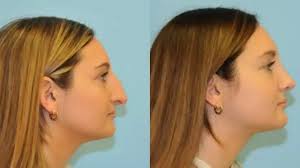 Berlet Plastic Surgery New York| Bookings Closing Soon