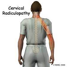 Pin By Dr Nicholas Carlisle Atlant On Common Chiropractic Conditions Cervical Radiculopathy Pinched Nerve In Neck Pinched Nerve